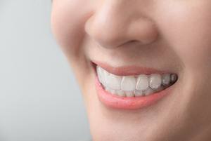 Patient smiling while wearing clear aligners