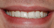 Mouth with evenly spaced teeth