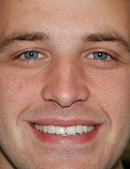 Man smiling with evenly spaced teeth