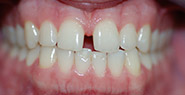 Mouth with gap between two front teeth