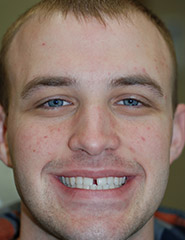 Man smiling with gap between two front teeth