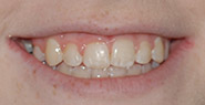 Smile with straighter teeth