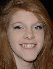 Young woman smiling with straighter teeth