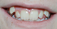 Mouth with severely crooked teeth