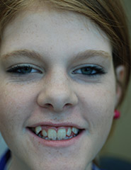 Young woman smiling with severely crooked teeth