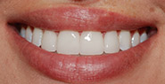 Smile with whiter and straighter teeth