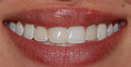 Smile with slightly stained and misaligned teeth