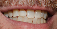 Smile after correcting slightly gapped teeth