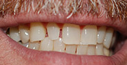 Smile with slightly gapped teeth