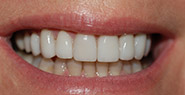 Smile with whiter teeth