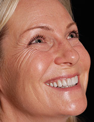 Blonde woman smiling with whiter teeth