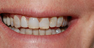 Smile with several stained teeth