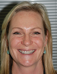 Blonde woman smiling with stained teeth