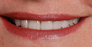 Smile with whiter and more evenly aligned teeth