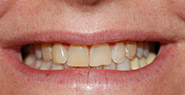 Smile with discolored and slightly crooked teeth