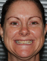 Brunette woman smiling with discolored teeth