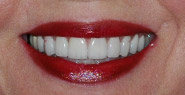 Smile with bright and newly restored teeth