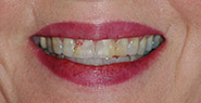 Smile with damaged and darkened teeth