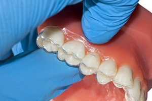 Invisalign aligner on dental mold