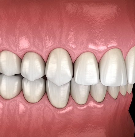 Illustration of an overbite