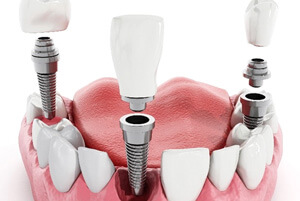 parts of dental implants replacing lost teeth