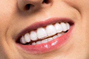 Straight teeth aren’t all about looks – having a perfect smile can increase your overall dental health. Invisalign in Virginia Beach, VA is right for you! 