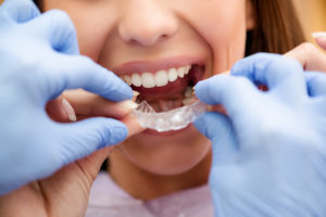 Woman getting Invisalign clear braces