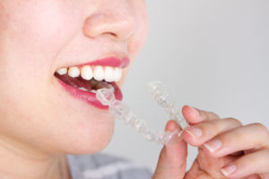 woman smiling inserting invisalign