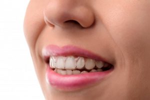 woman fixing TMJ with Invisalign