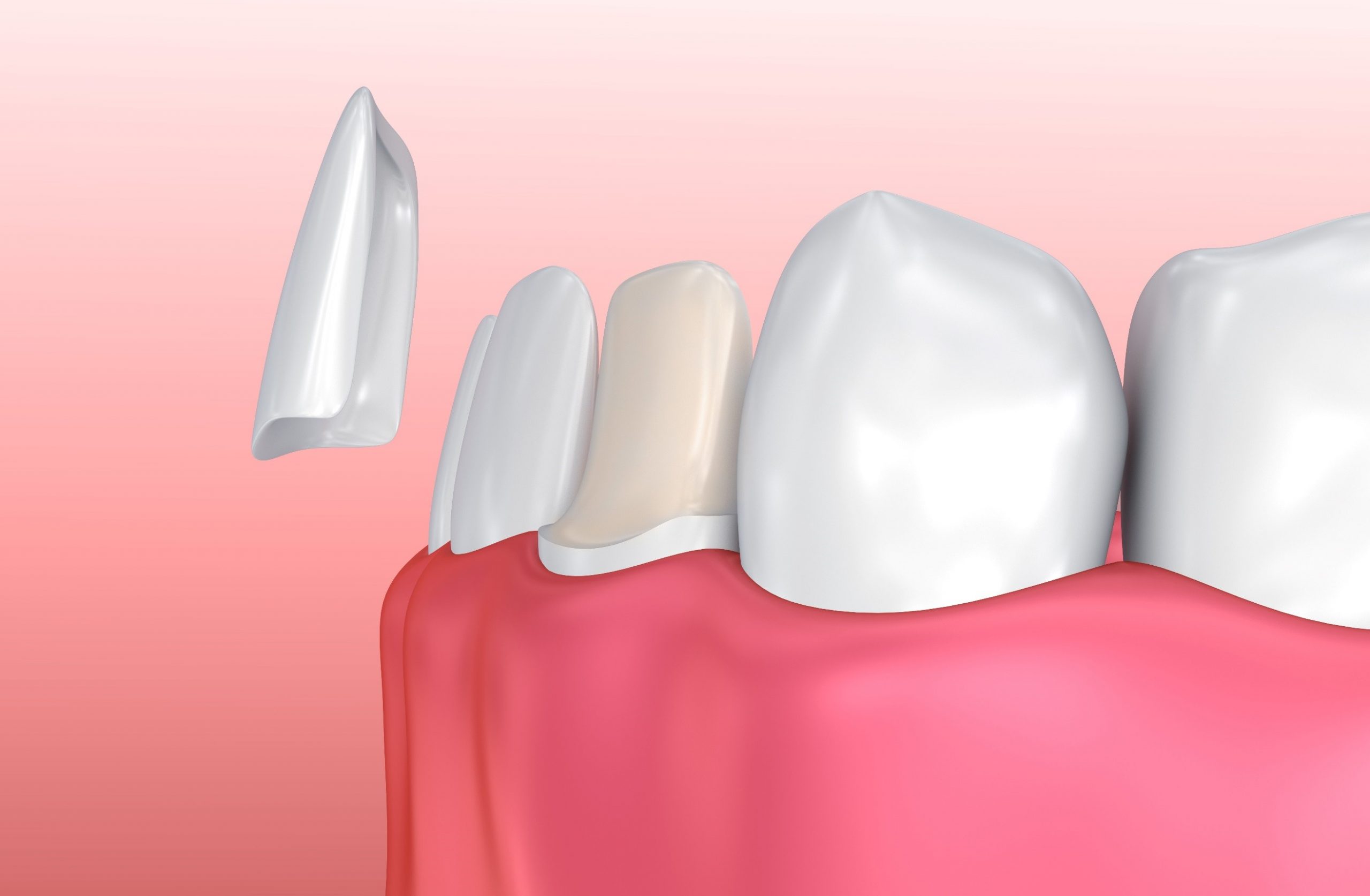 How Much Enamel Needs to Be Removed for Veneers?